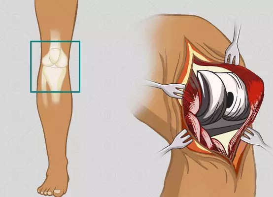knee-replacement-arthroplasty-in-hindi